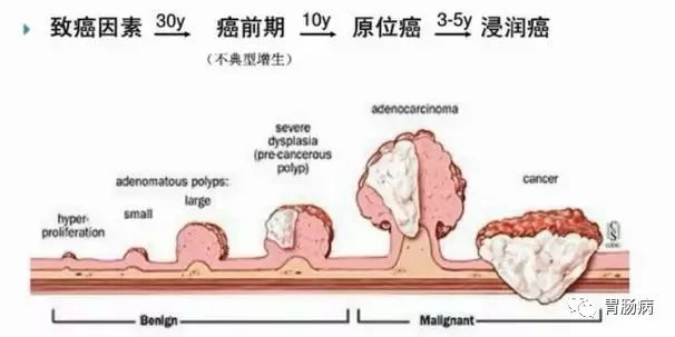 體檢查出腸息肉一定要切除！ 95%腸癌由它演變而來
